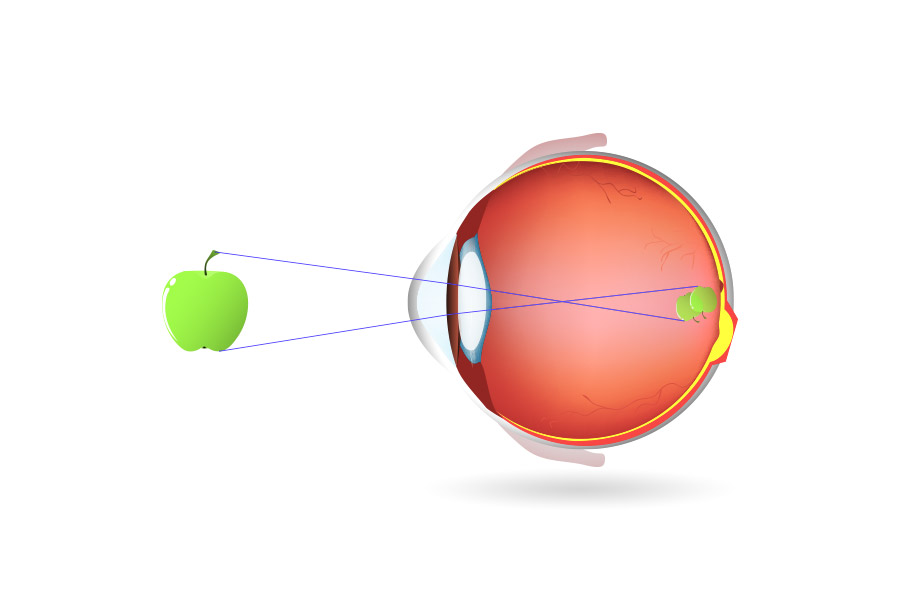 astigmatism