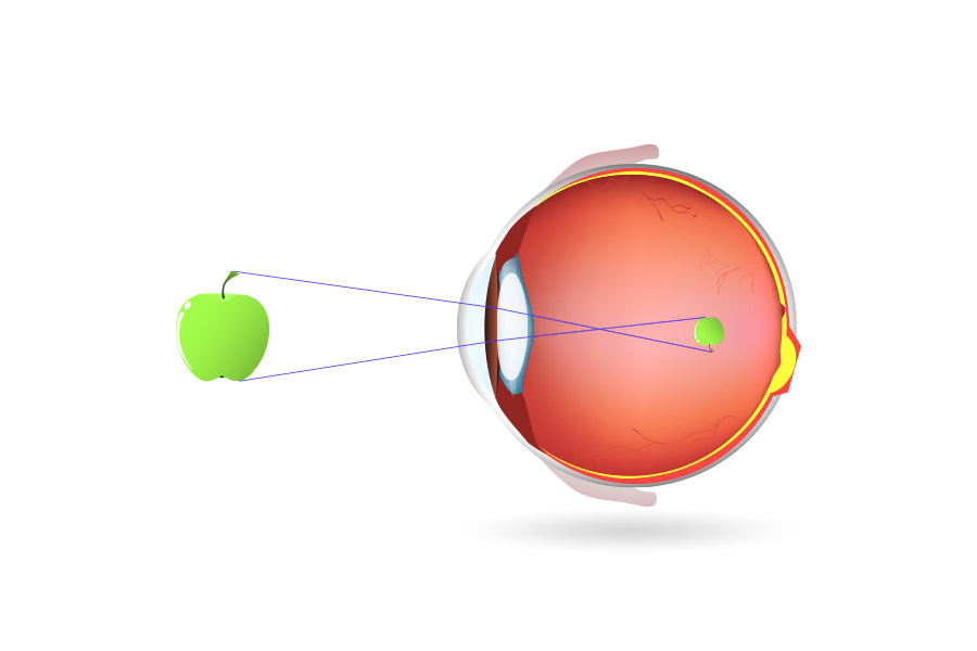 myopia