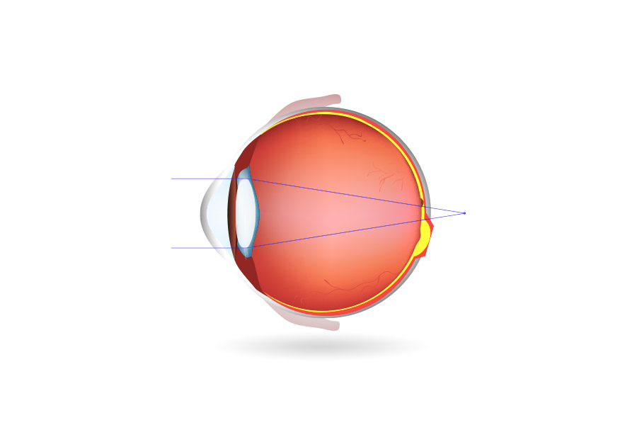 presbyopia