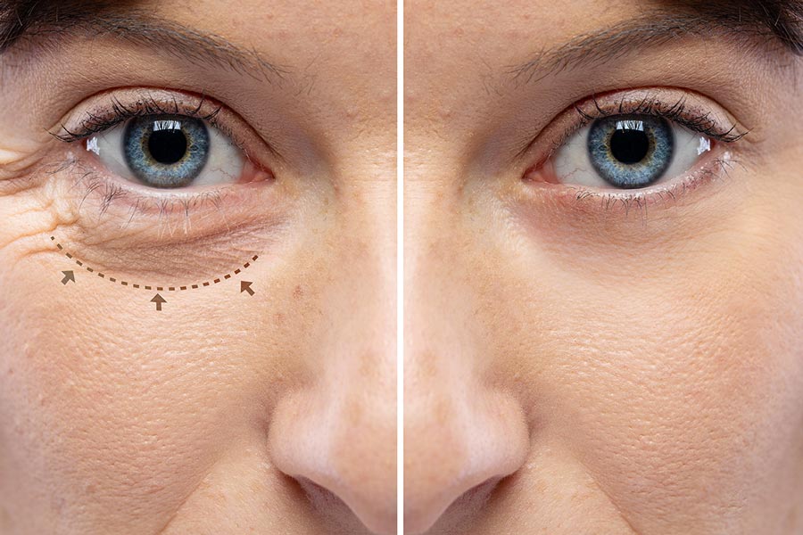 vorher-nachher-unterlider Schlupflider, Ptosis sowie allgemeine Lidchirurgie im Augenzentrum ONO